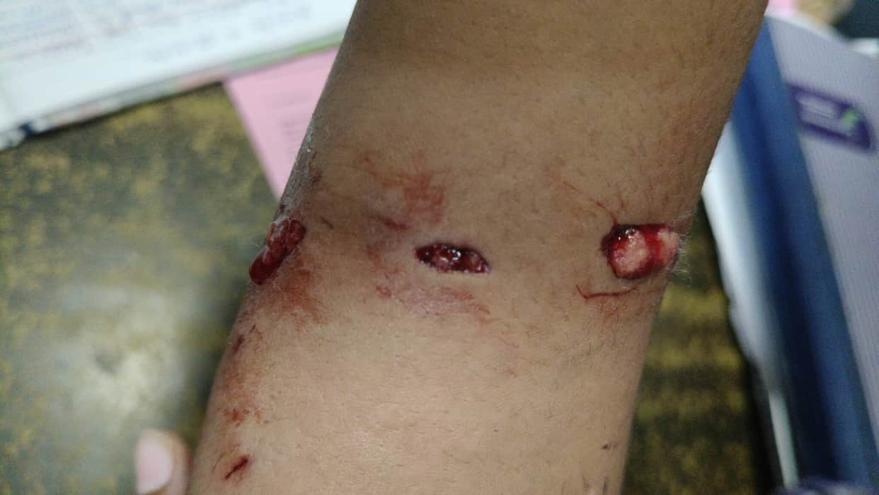 Dogs bit a 12-year-old child in the MLA residence complex