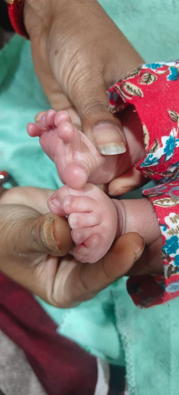 पालमपुर अस्पताल में हाथ और पैरों की छह-छह उंगलियों वाली बच्ची। -स्रोत ः स्वास्थ्य विभाग