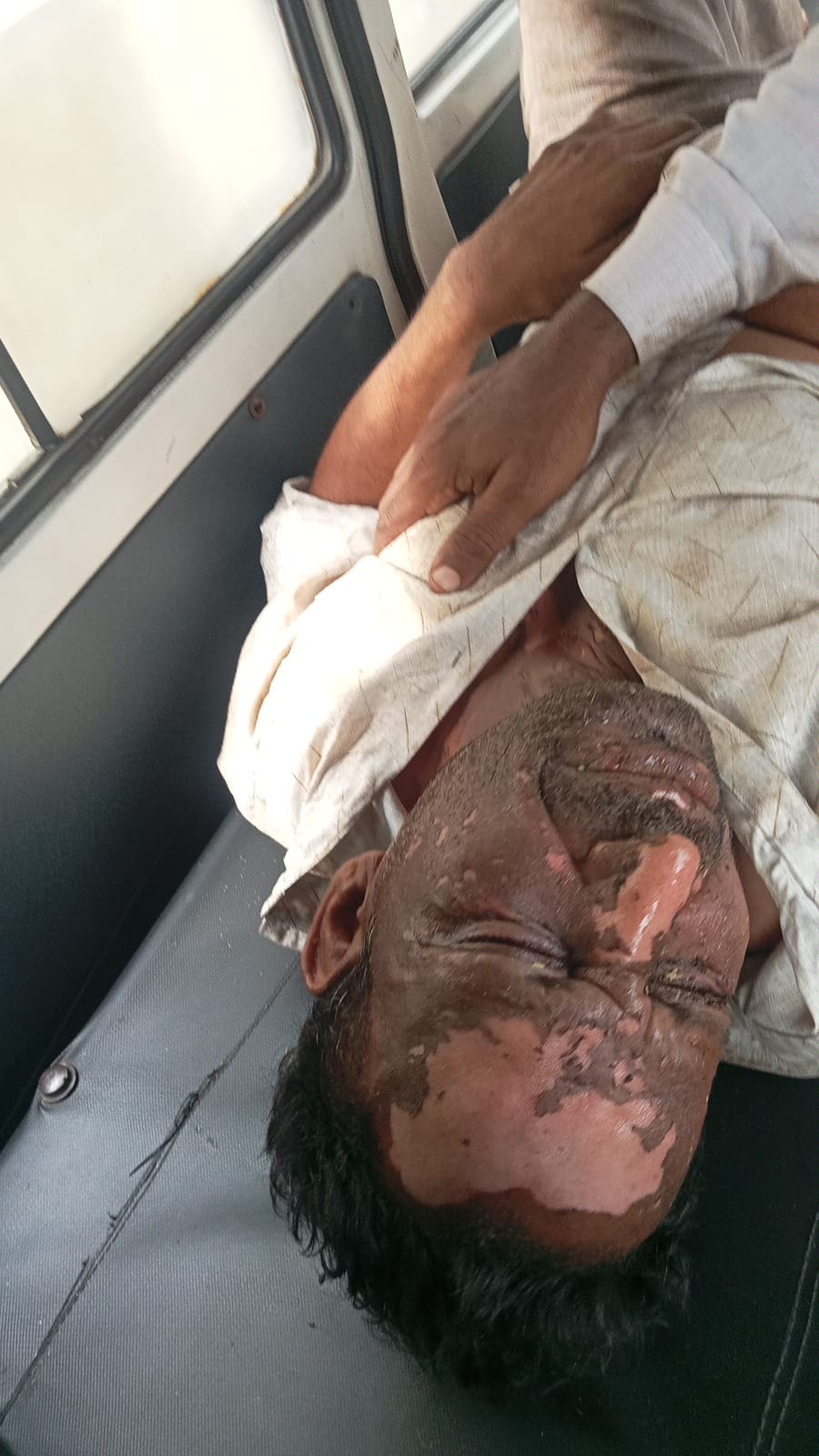 Contract lineman suffers burn injuries after power supply suddenly resumes after shutdown