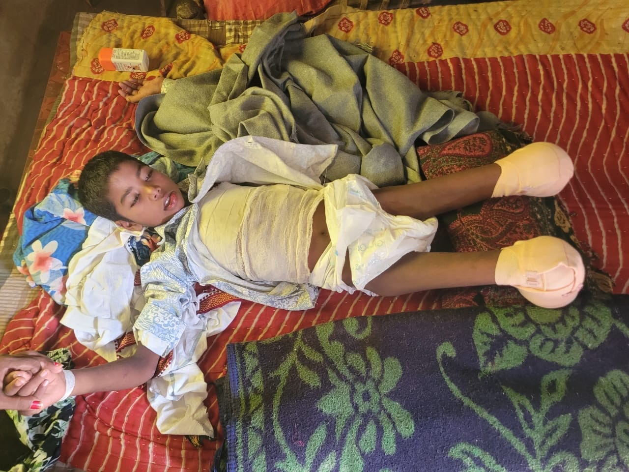 मासूम बच्चे का कटा पैर। परिजन