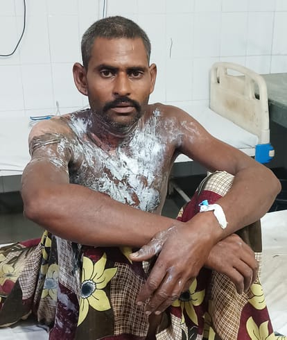बाह: गैस सिलिंडर की आग से झुलसा खेतलीपुरा का सतीश