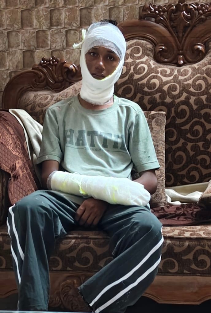 झिंझाना के बिडौली सादात में रेफ्रिजेरेटर का कंप्रेसर फटने से लगी आग में झुलसा युवक। संवाद
