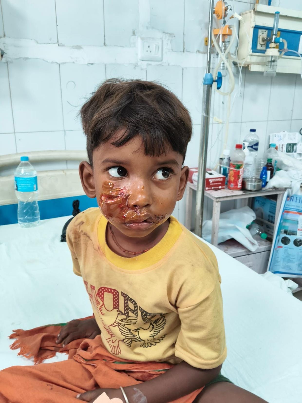 Dog attacks five-year-old child; condition critical.