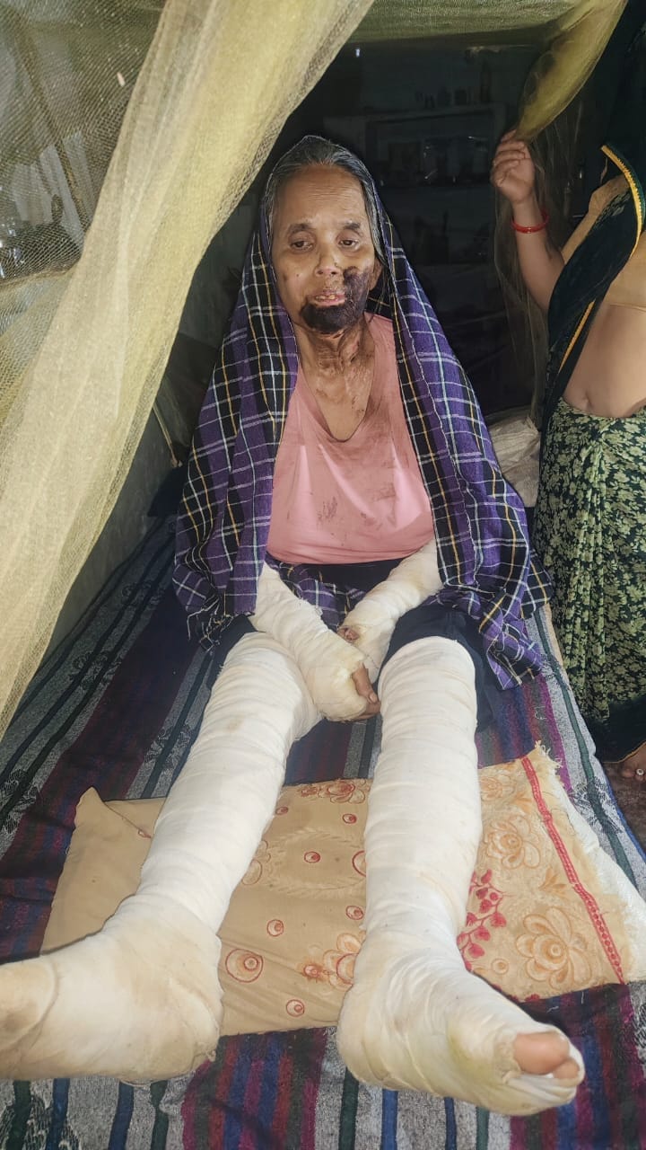 Fire breaks out in gas cylinder while cooking; elderly couple suffers burns.