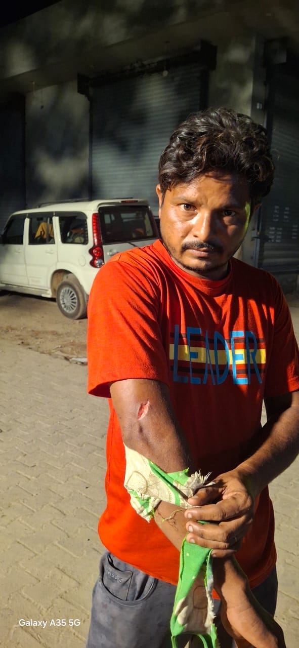 बंदर द्वारा काटने के बाद लगी चोट दिखाता अंबेडकर कॉलोनी निवासी शिंदा।