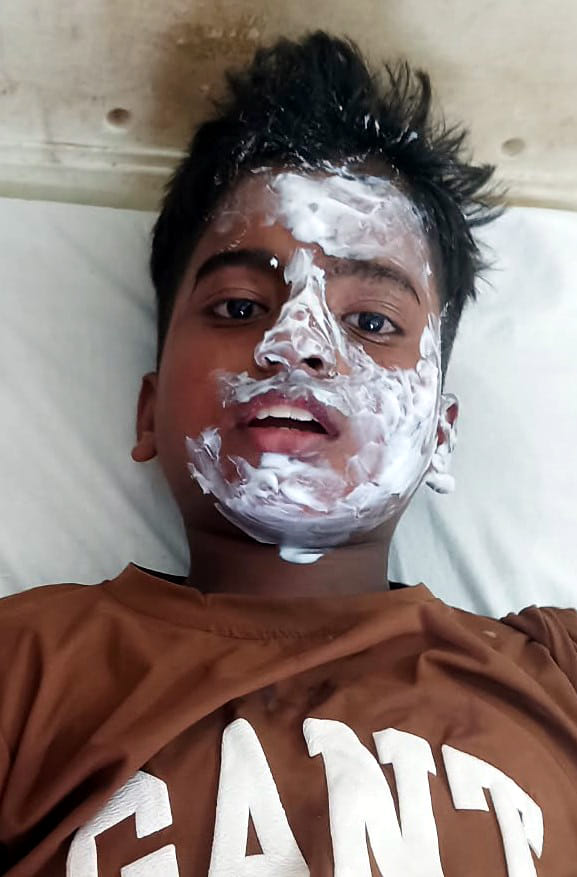 Spark erupts while cleaning potash gun; student's face scorched.