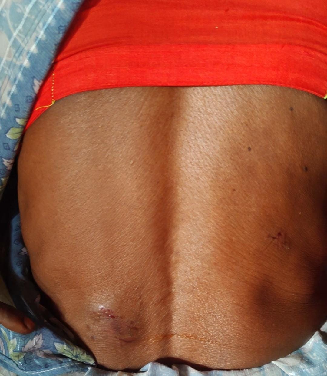 बंदर के हमले में घायल अनौनी गांव निवासी श्यामदेई। संवाद
