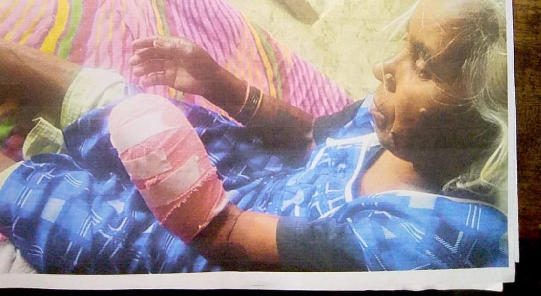 Female patient had to have her hand amputated due to infection from an incorrect injection