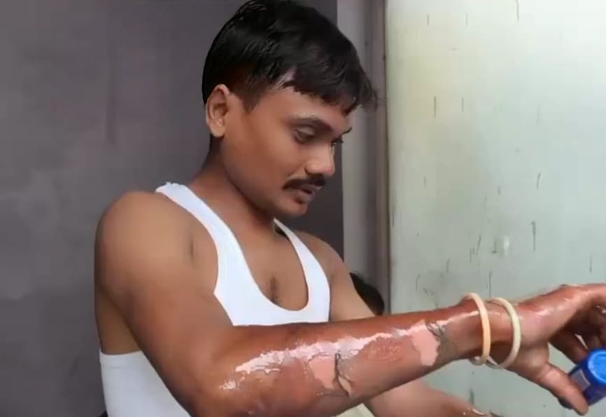Fire breaks out at petrol pump premises due to short circuit, one worker suffers burns