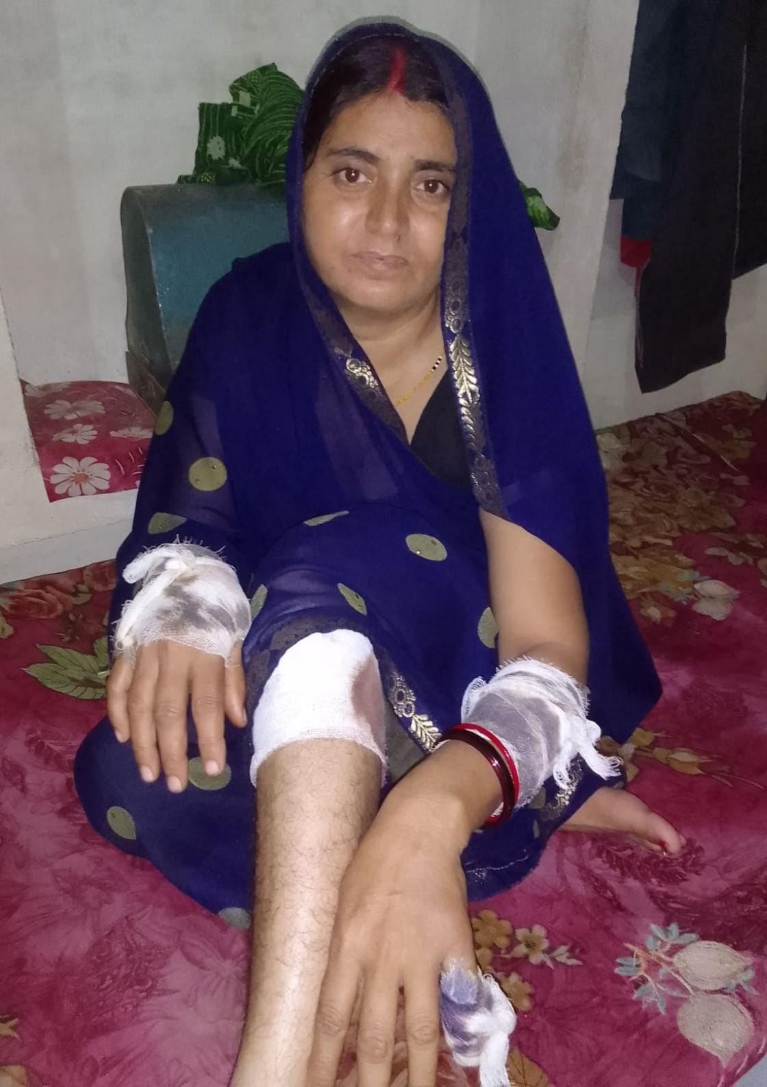 फोटो-16- कुत्ते के हमले से घायल अर्चना पटेल। स्रोत ग्रामीण