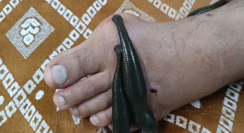 Using leeches to treat skin diseases