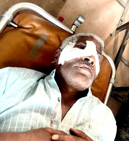 परीक्षितगढ़-  लंगूर के हमले से घायल मजदूर चौहल।