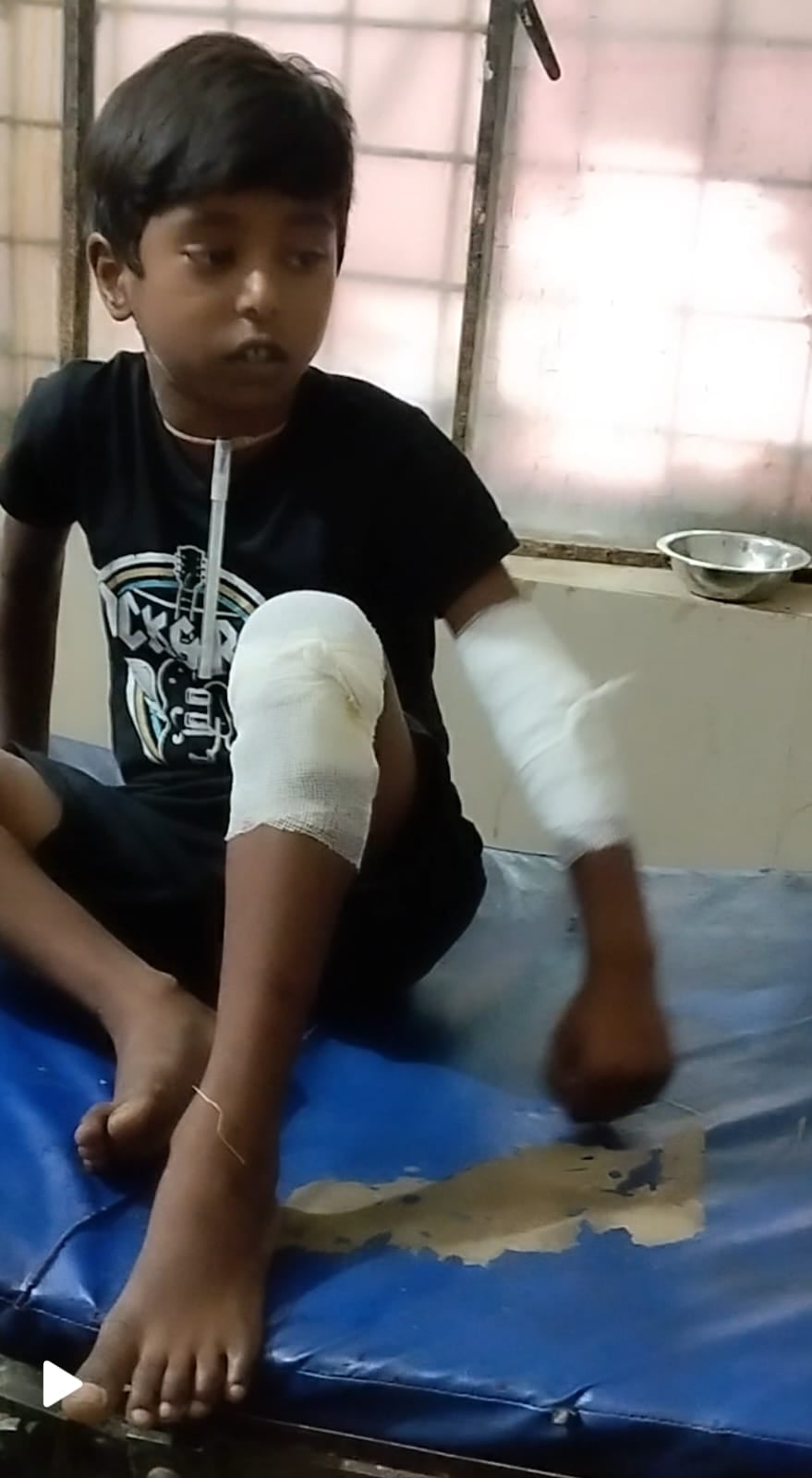 Hamirpur News: बंदर ने छात्र पर हमला कर किया लहूलुहान