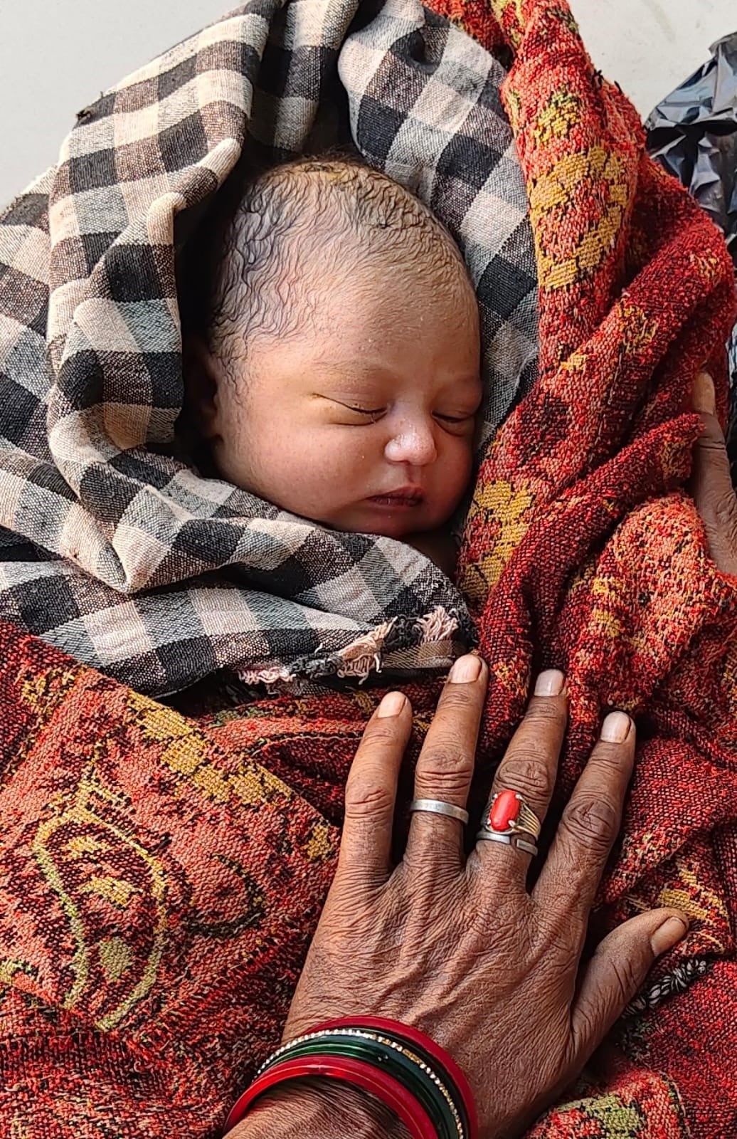 Condition deteriorated after childbirth; death ensued.Condition deteriorated after childbirth; death ensued.