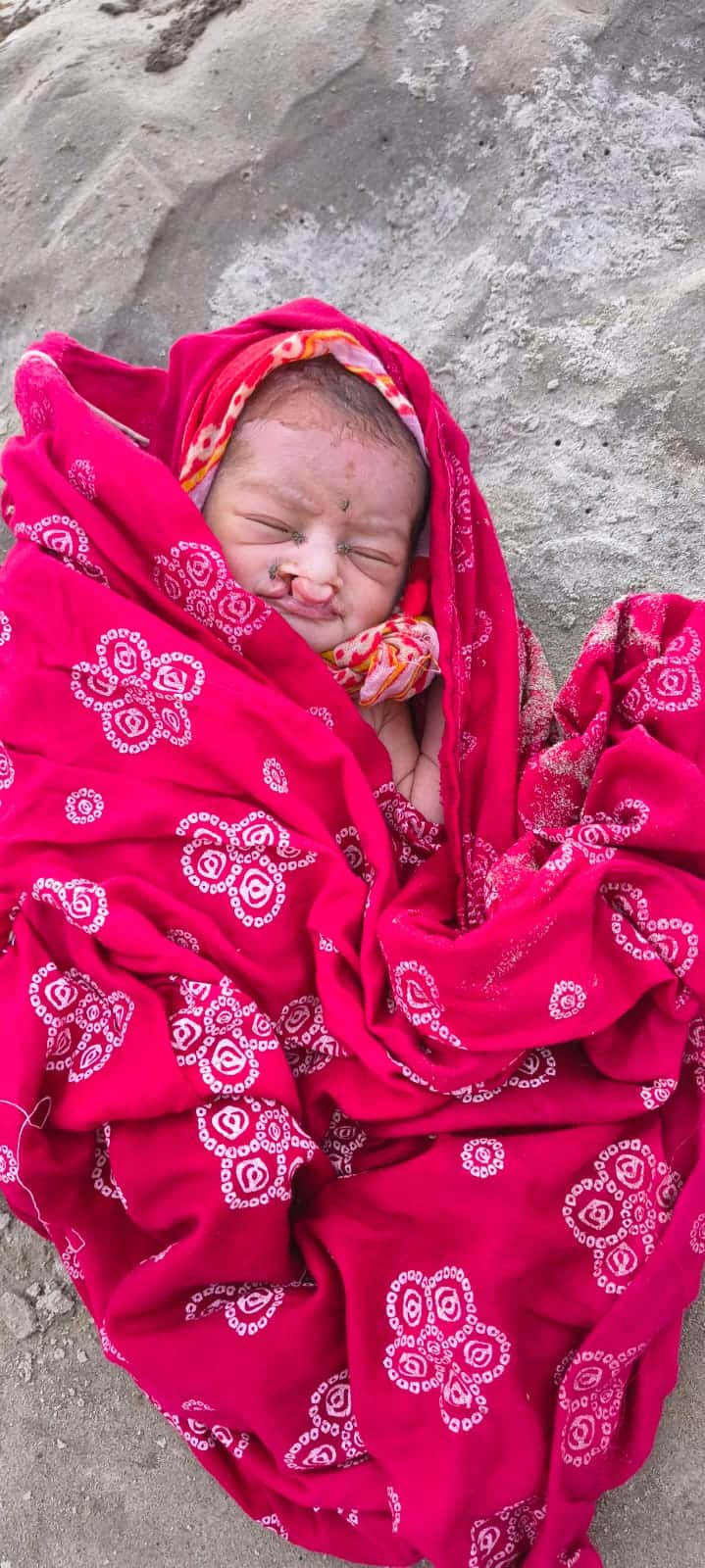 Newborn girl found with cleft lip under Jayprabha Setu, admitted to CHC Manjhi: