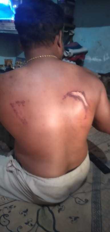 Sanitary workers sprayed with burnt back