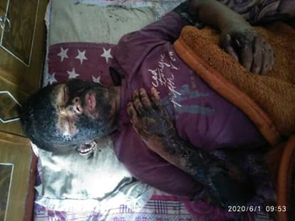 Father and son scorched in home due to lightning in Bedinag.