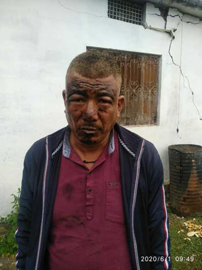 Father and son scorched in home due to lightning in Bedinag.