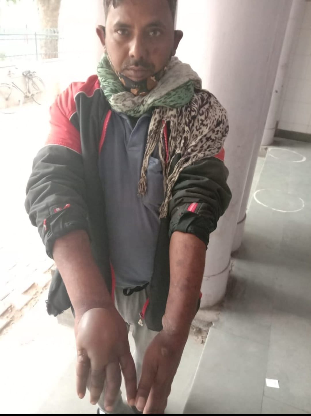 रंजिश में हलवाई पर डाला खौलता तेल, सिर फोड़ा