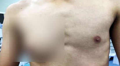 Chinese Boy Grows A Single A-cup Breast On His Chest Due To Fast Food -  फास्ट फूड के असर से लड़का खोने लगा अपनी पहचान, डॉक्टरों ने ऐसे बचाया -  Firkee.in