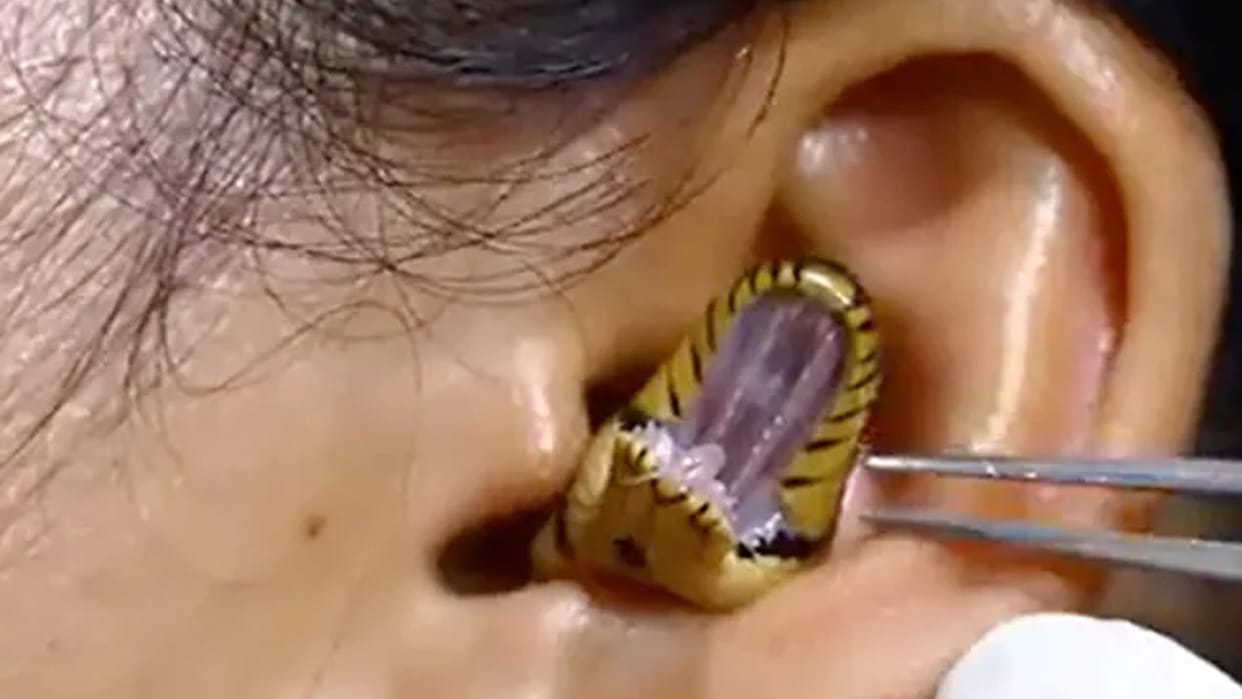 snake entered in girls ear the doctor tried to remove it video viral