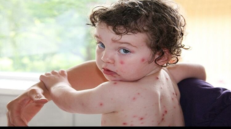 Chickenpox: जानिए क्या होता है चिकनपॉक्स संक्रमण, नाम में है चिकन तो