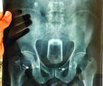man stuck beer glass in rectum uto ease constipation