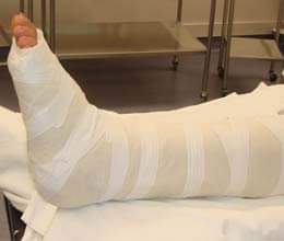 now fracture will improve speedily