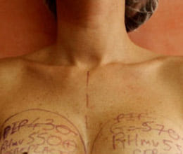 cosmetic surgery views sought after breast implant scare