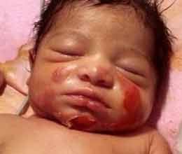 newborn baby burnt due to staff negligence 