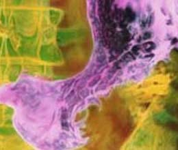 night shift work may cause cervical cancer