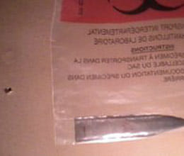 knife sunk in back for three years