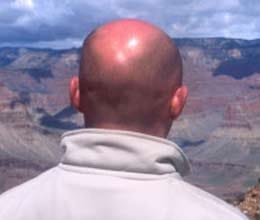baldness indicates heart disease risk