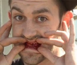 dentist pulls all teeths of patient without permission