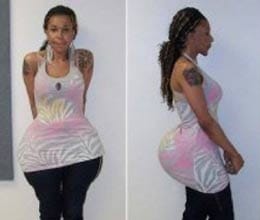 woman gets cement injections in Butt in miami