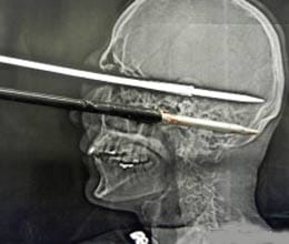 fired 6 inch harpoon in head he was alive