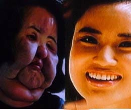 Woman want soft face filled cooking oil in face through injection