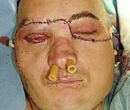 first life-saving face transplant on man