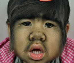 chinese girl with rare genetic werewolf  syndrome