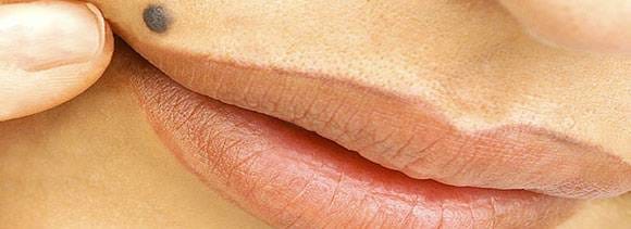 moles and birth signs can be sign of skin cancer 