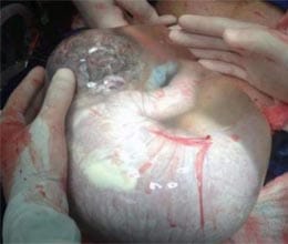 premature baby