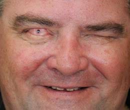  man having a tooth implanted into his eyes