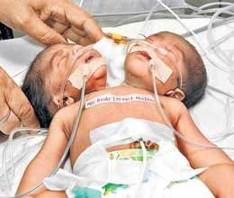 child with two head died