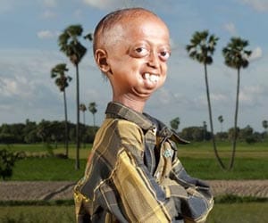 boy suffering from rare disease