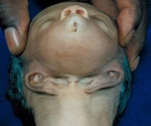 baby born with ears under its chin 