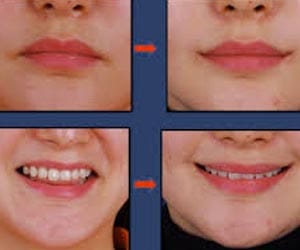 New plastic surgery procedure gives you permanent smile