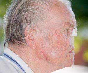 Cancer victim loses nose on trip to dentist