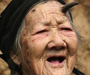 shocks as woman grows HORN on her head 