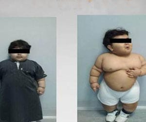 aged 2 becomes youngest in world to have weight loss surgery 