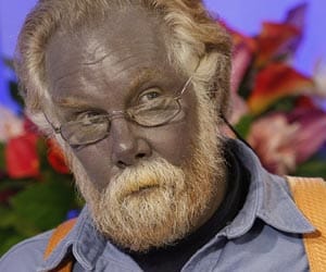 Man who found Internet fame when his skin turned permanently blue dies